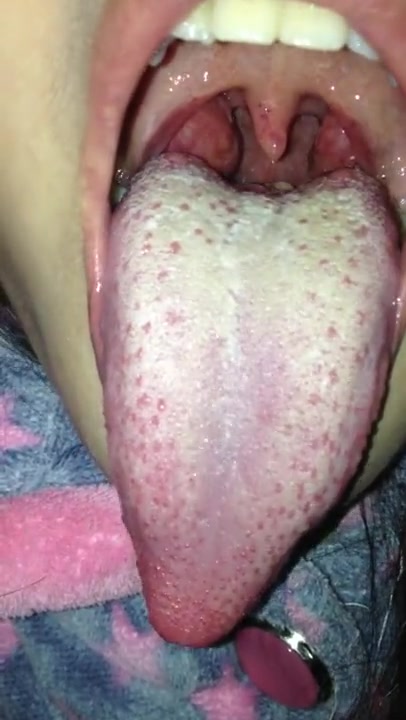 Asian girl long uvula