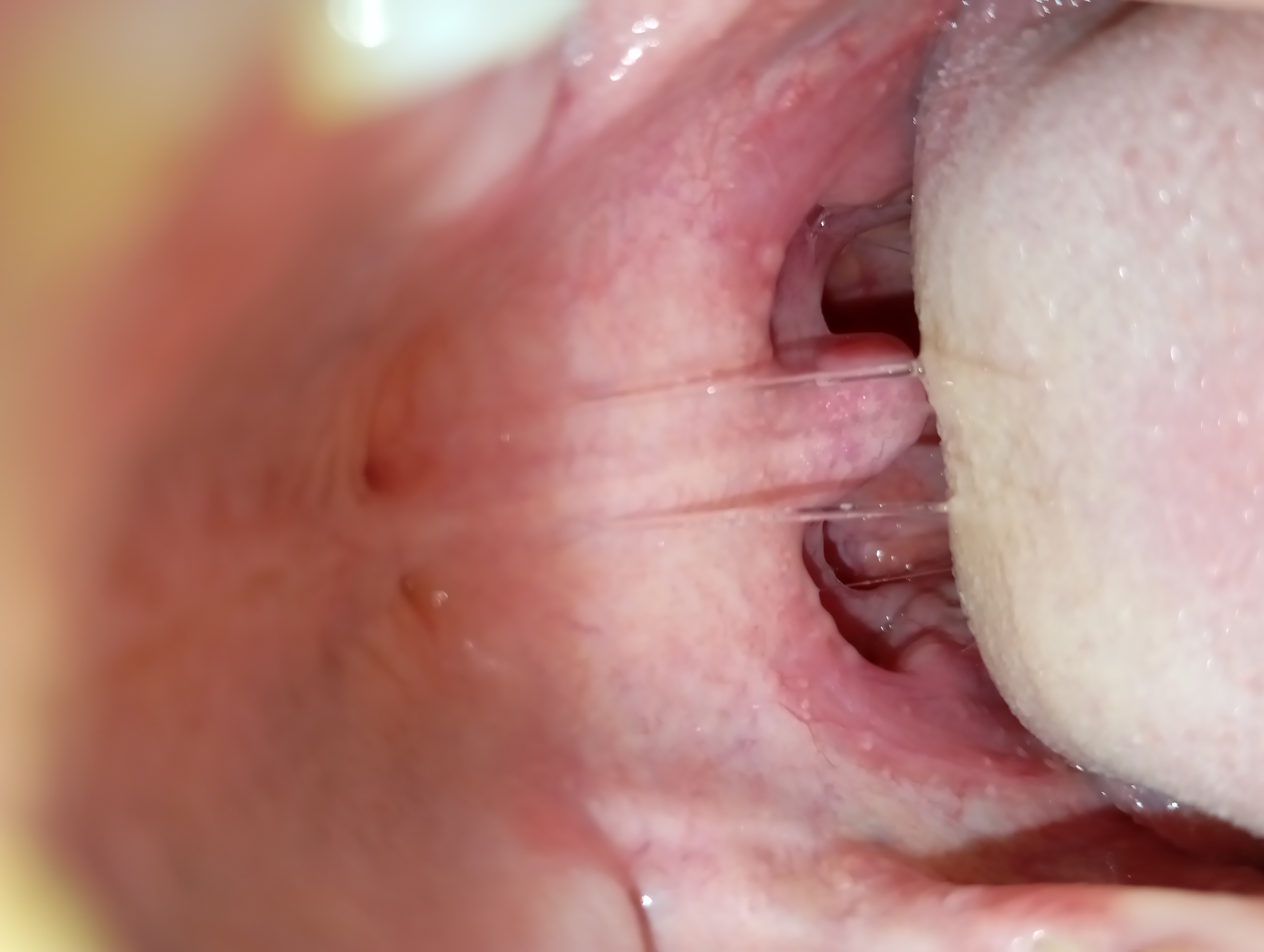 My uvula in the morning 