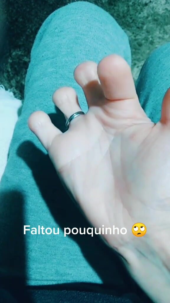 finger amputee - video 3