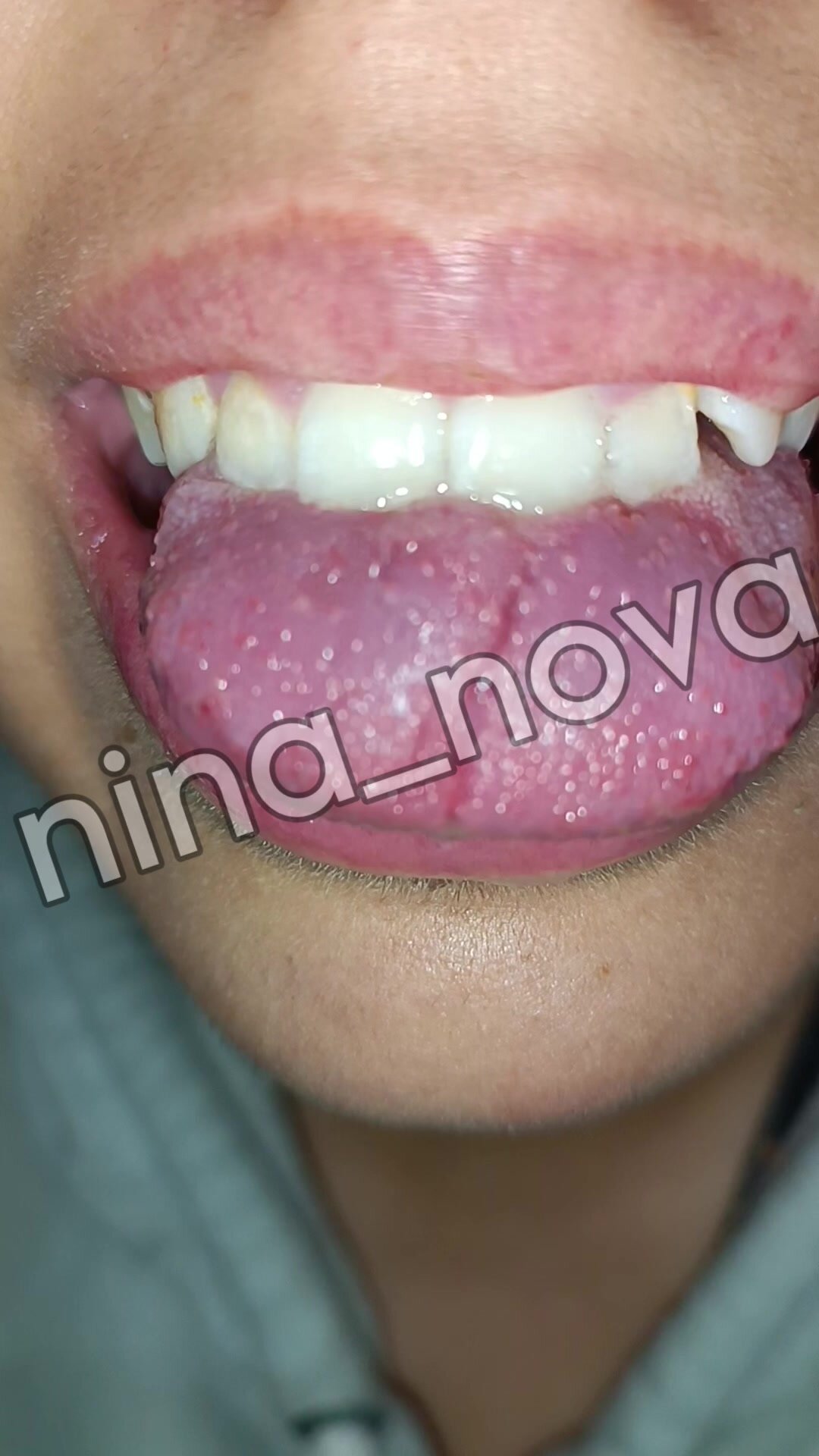 White tongue coating fungs