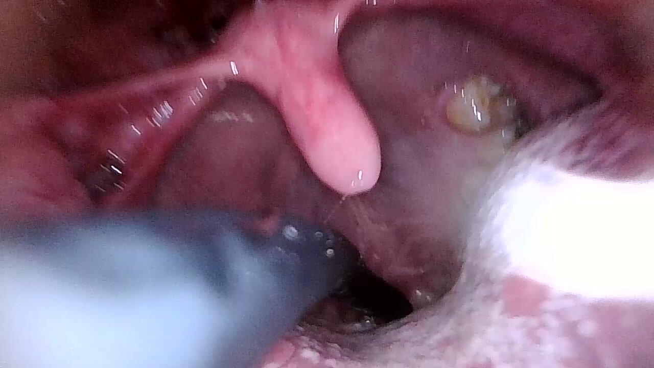 Endoscope swallow vore