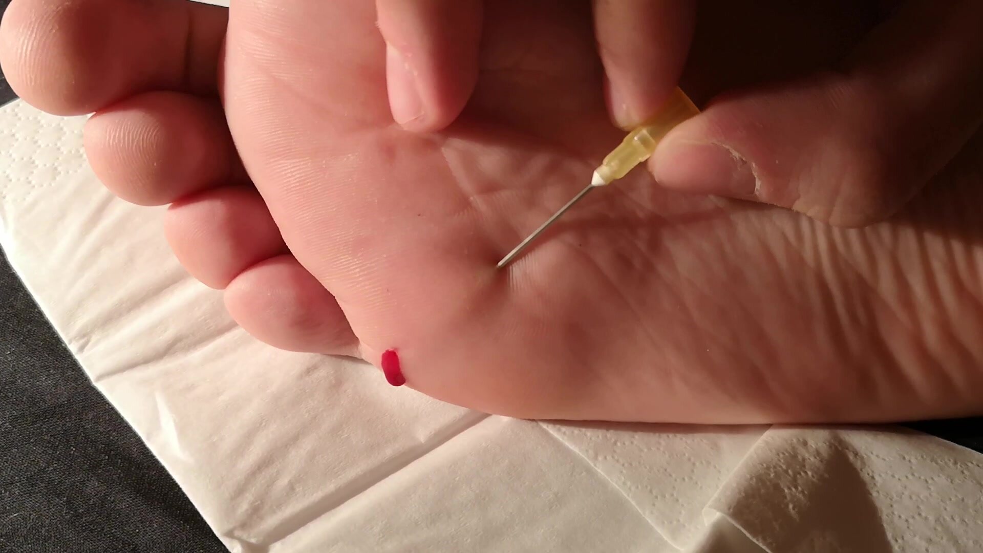 Removing needle from male foot