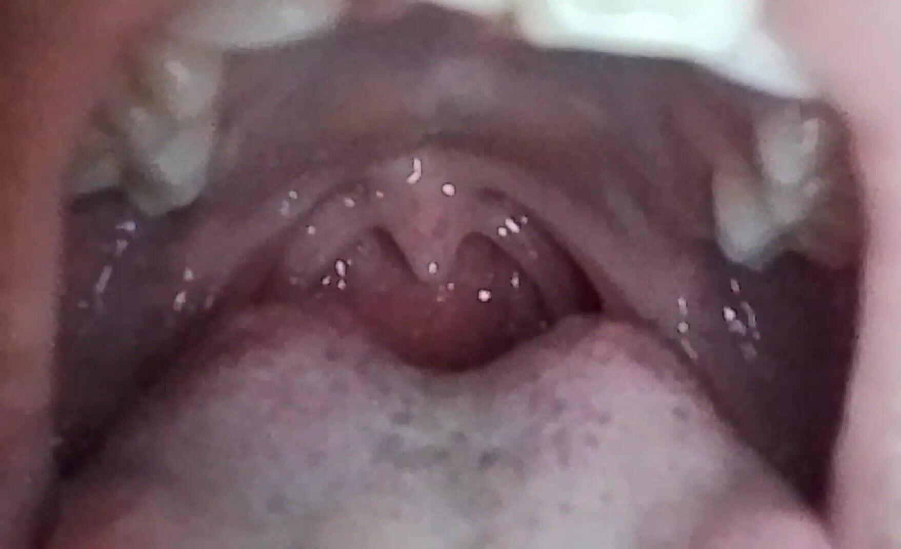 Another uvula of my friend