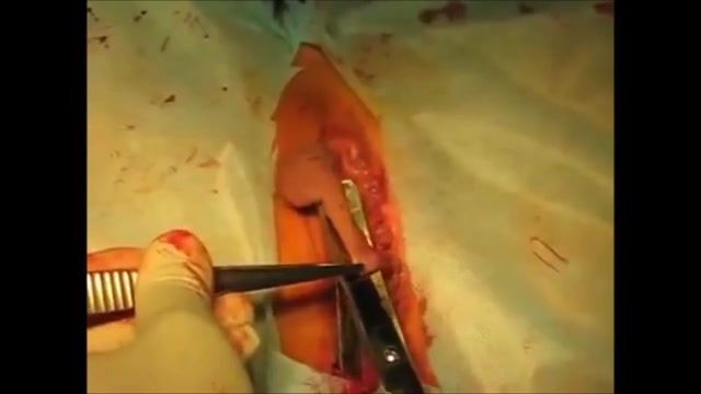Doctors make a vaginoplasty