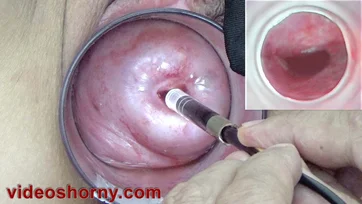 Uteres Cam Naked Lady - Endoscope Camera inside Cervix Camera into Pussy - ThisVid.com