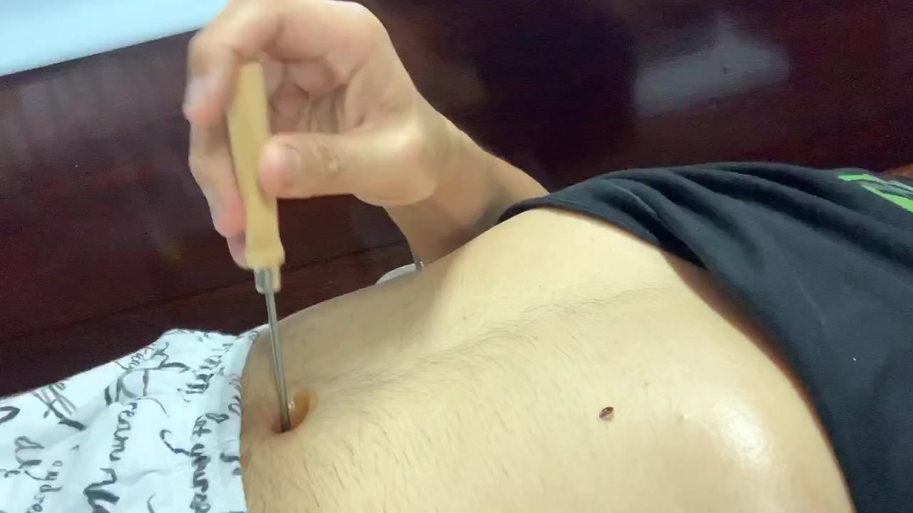 stabbed navel with ice picking