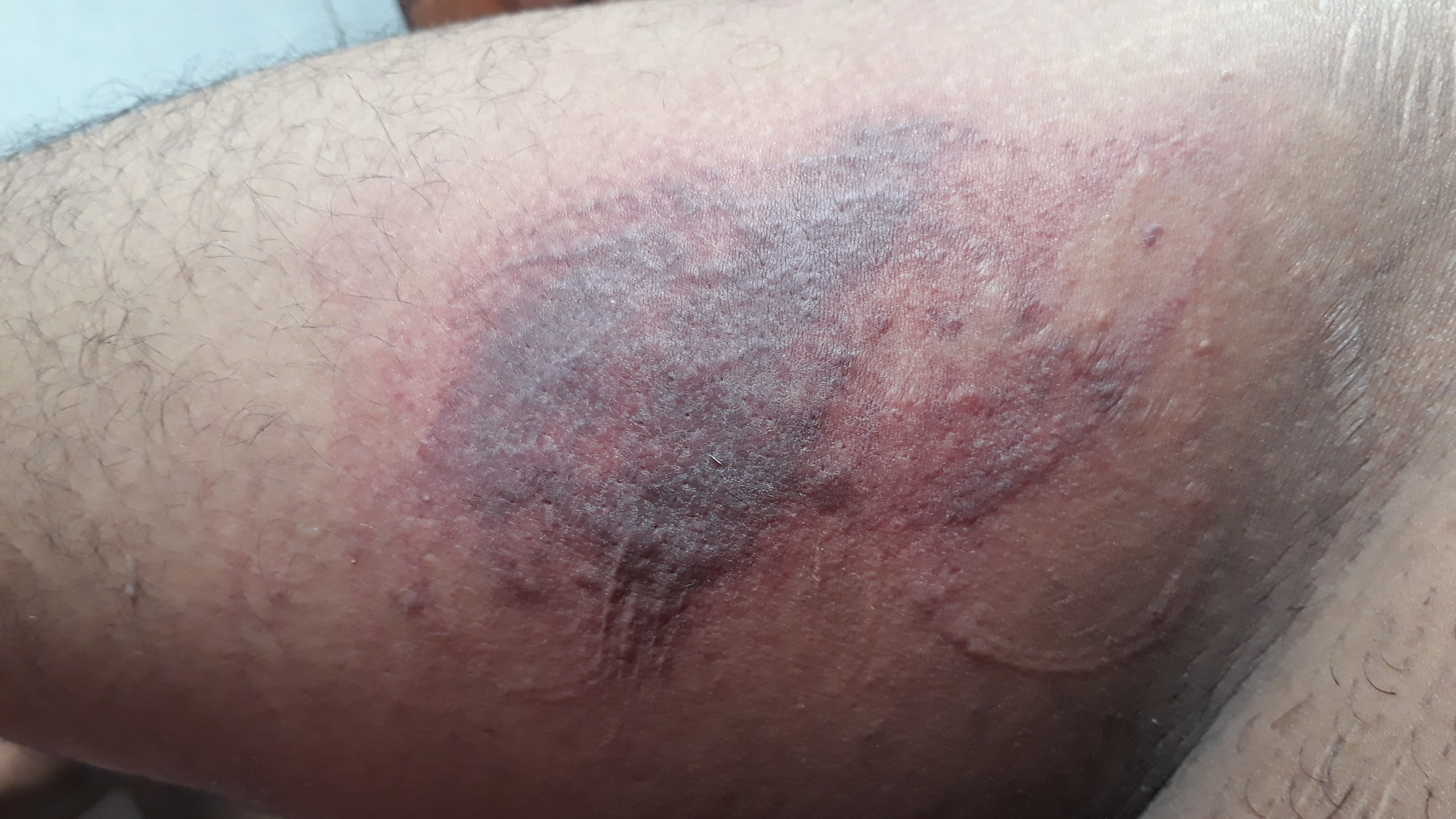 Pain and Pleasure - Bruising my thigh