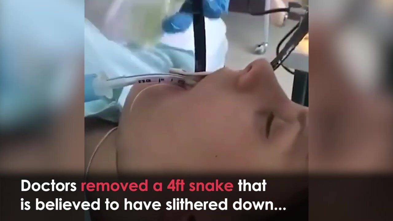 Digested 1.2m Snake Pulled from woman's stomach.