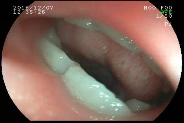 Girl Swallow The Endoscope ThisVidcom