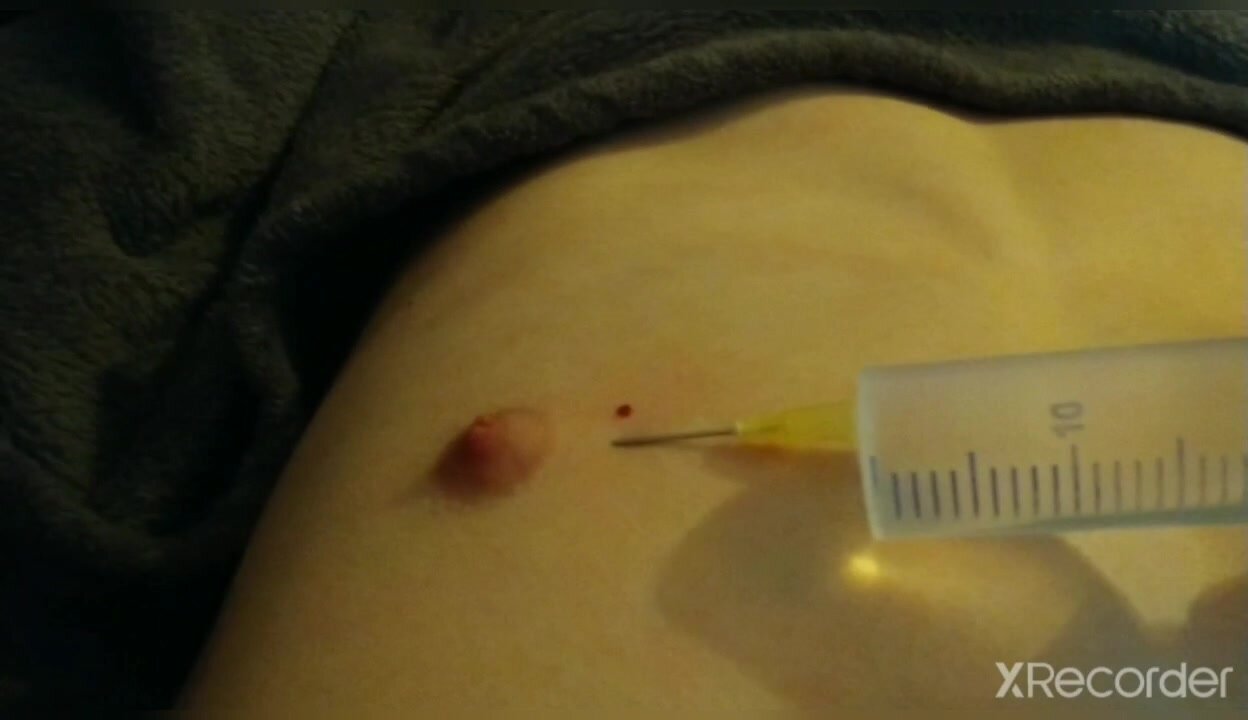 First Saline injection in nippel
