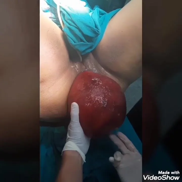 Fat Booty Anal Prolapse - Monster Anal Prolapse - ThisVid.com