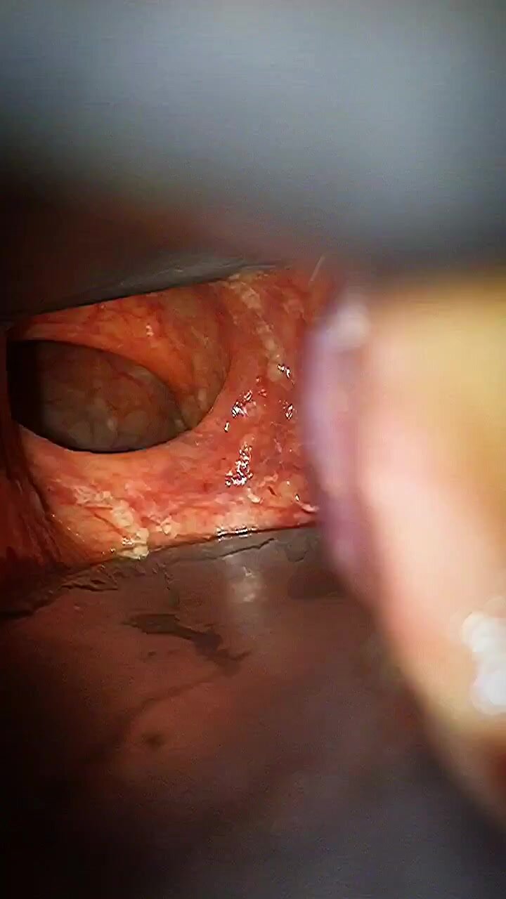 Rectal surgery - video 2