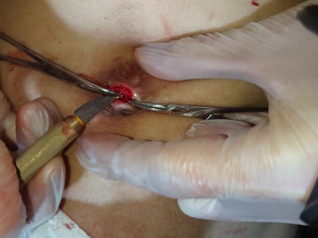 cut bellybutton tissue