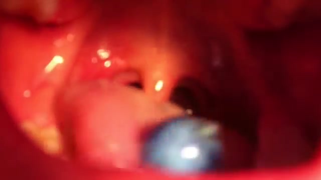 woman swallowed the glass beads2