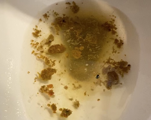 Diarrhea and Dripping Hole