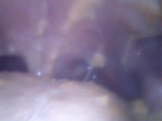 Swallowing cookie throat endoscopy