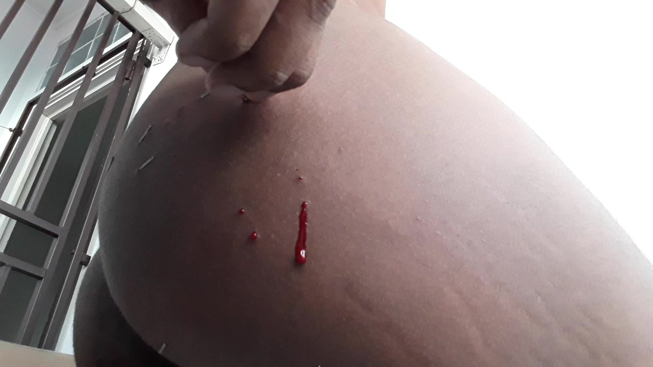 Removing staples from ass