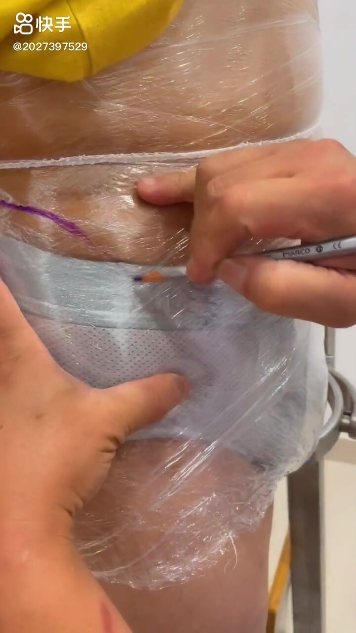 Hip amputee - video 4