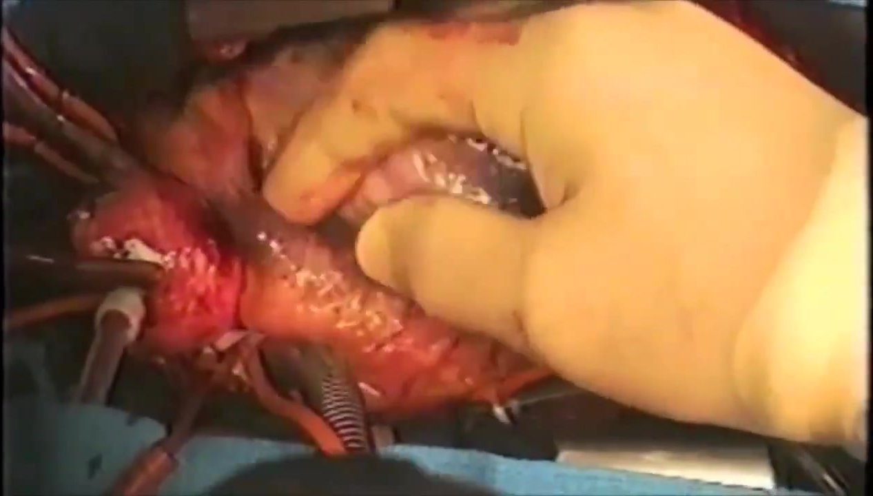 Heart Surgery Clip