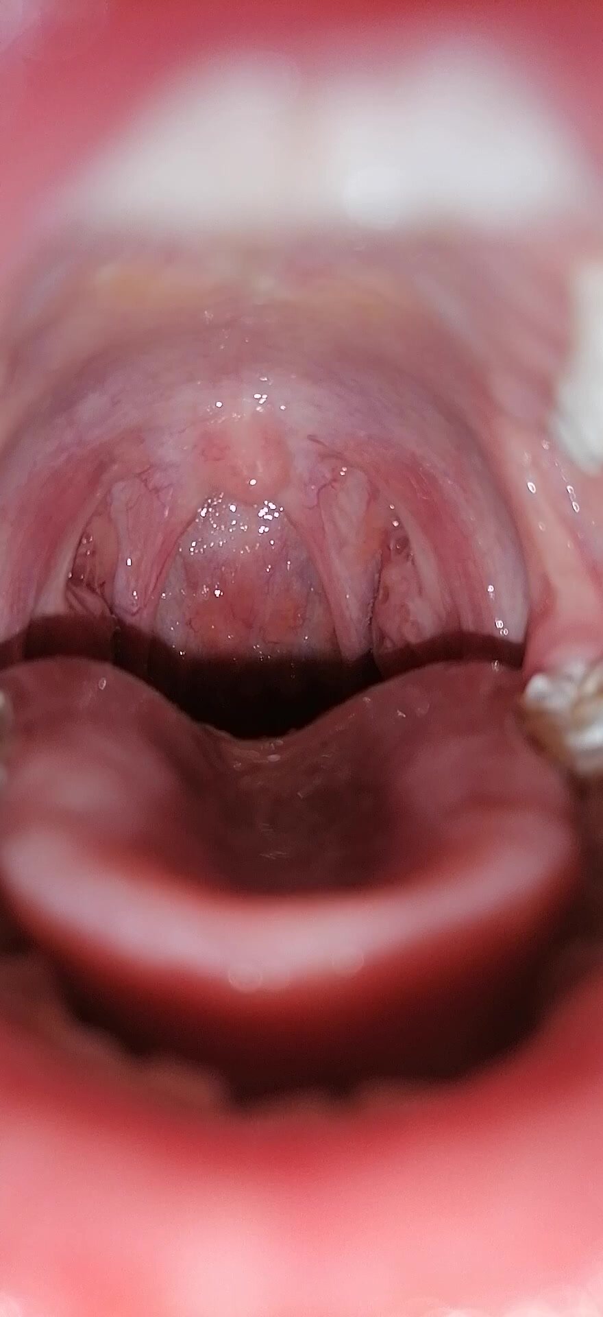 a short uvula view