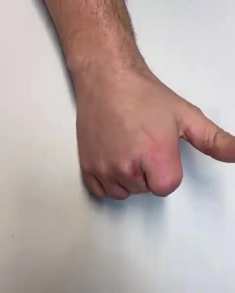 Fingers amputee
