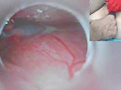 Insemination Cum into Uterus and Endoscope Camera