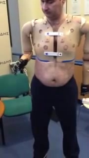 amputee DSD is trying his prosthesis