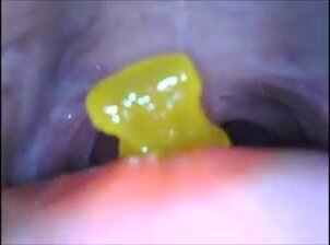 Girl swallowing gummy bears with endoscope