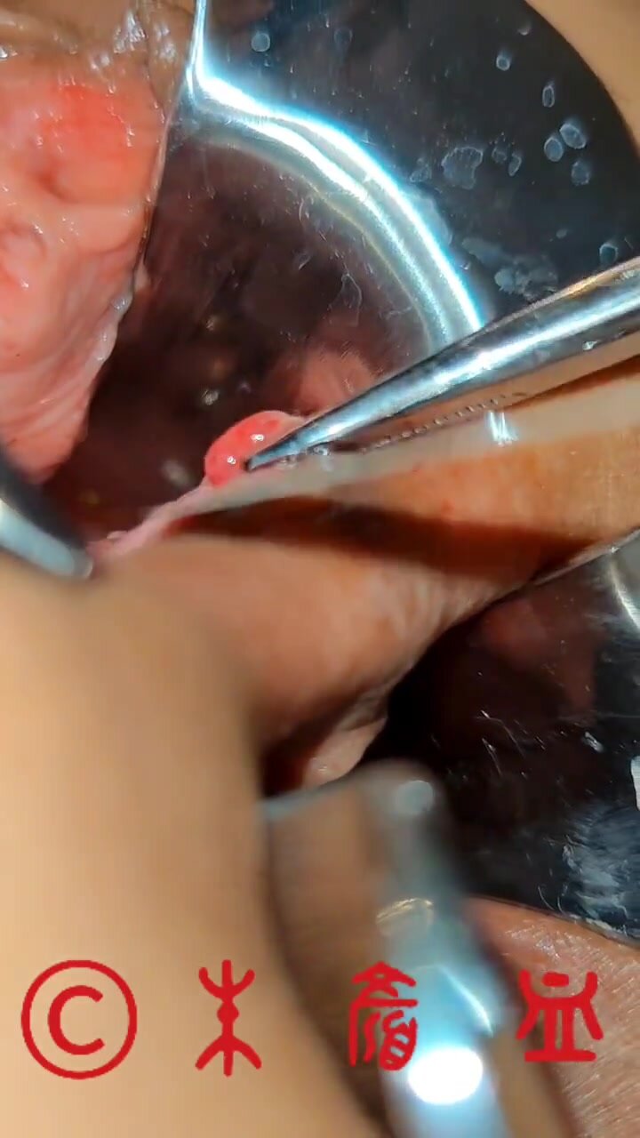 Pussy ass piercing cut off extra pussy meat