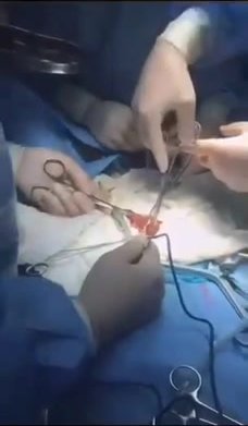 Doctors remove a HUGE dildo from lady’s anus