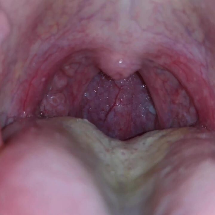 My uvula and throat #1