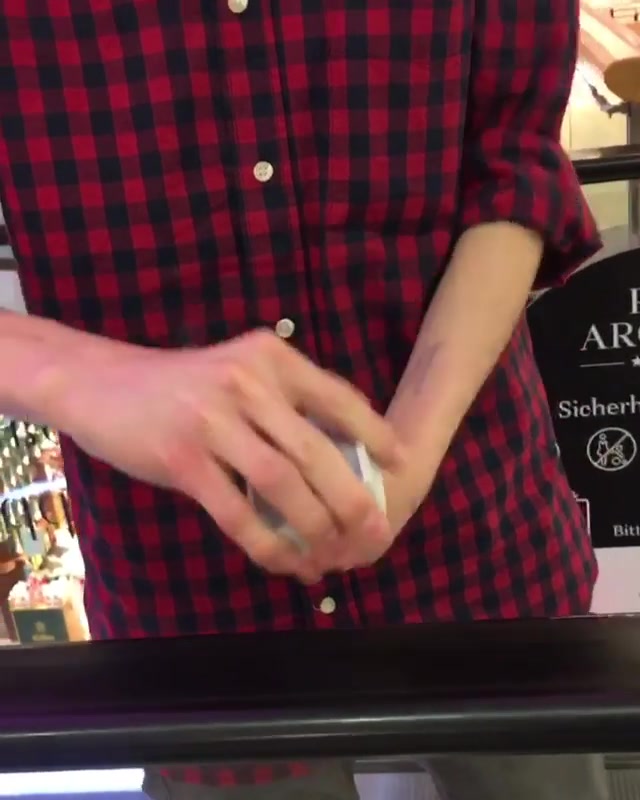 cogenital hand