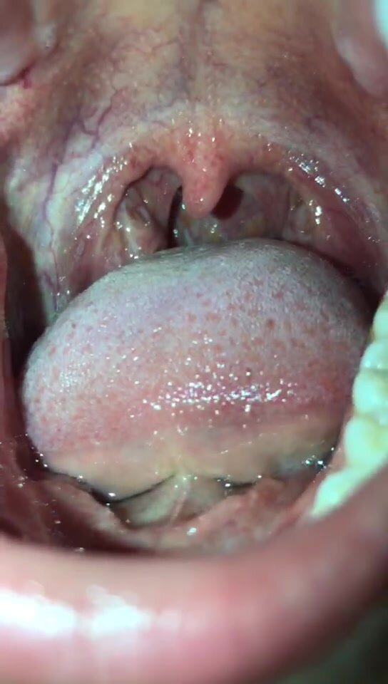 girl uvula and mouth