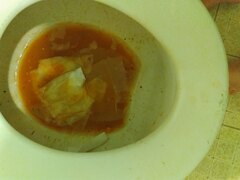 Diarrhea from Epsom Salt 1