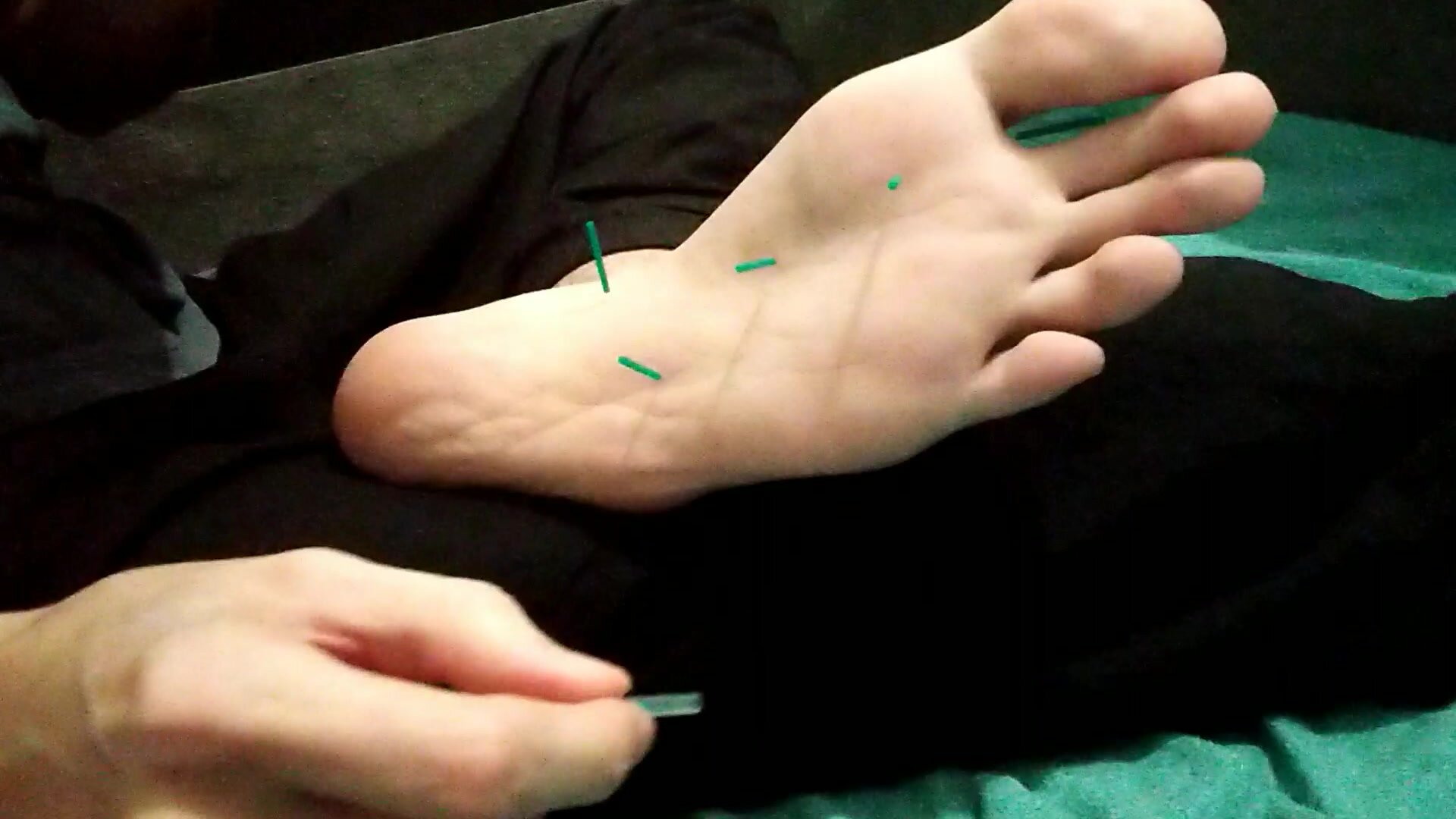 Twink feet acupuncture 1/2