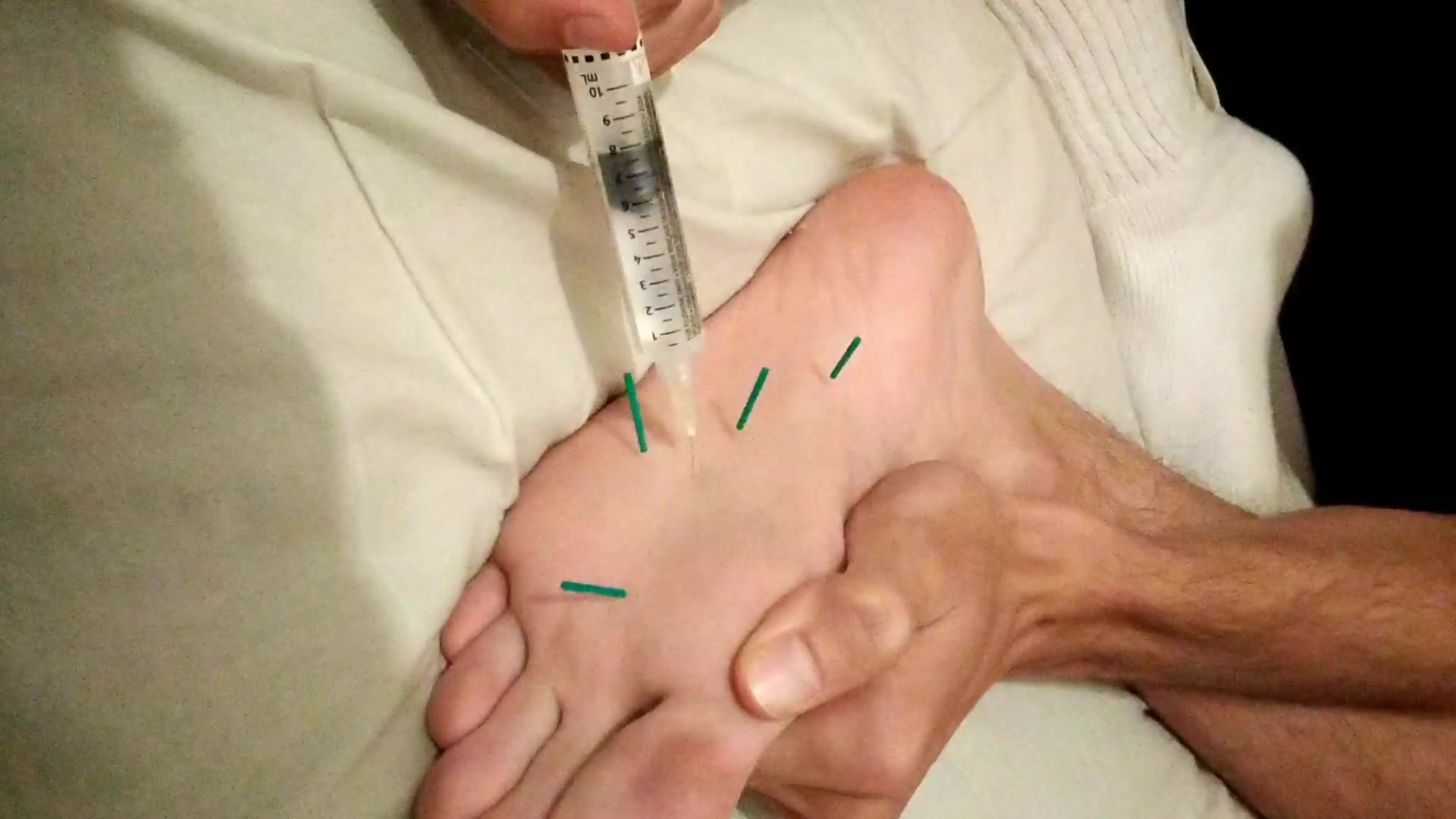 Twink feet acupuncture and injection 1/2