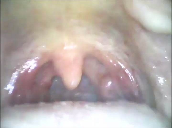 Alandra - Yawning uvula (Clip)
