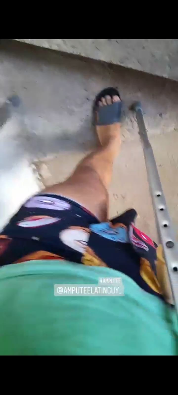 Amputee walking in shorts