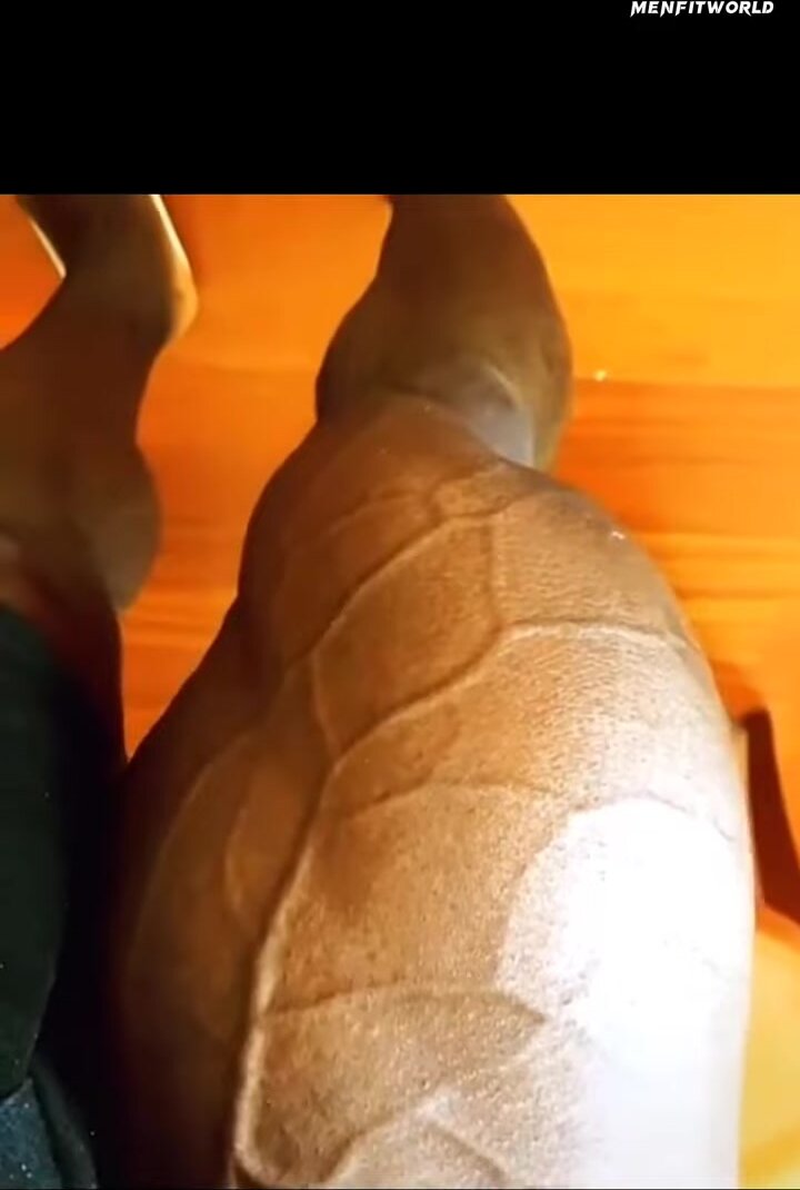 Super huge vascular legs