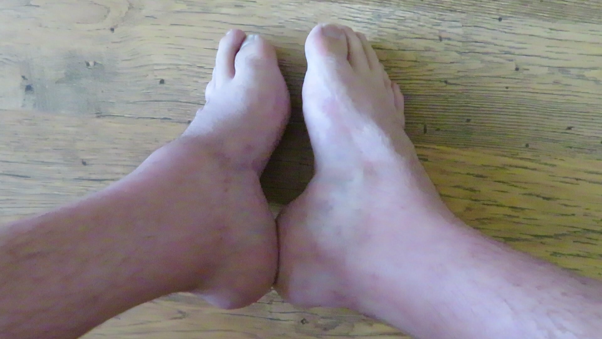 My deformed feet