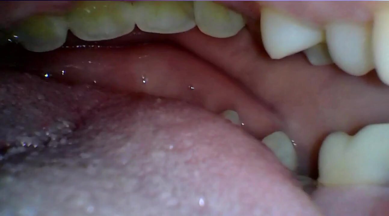 Reverse endoscope inside mouth pov looking out