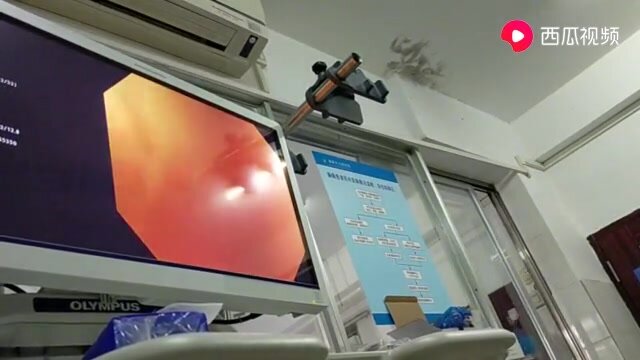 colonoscopy - video 5