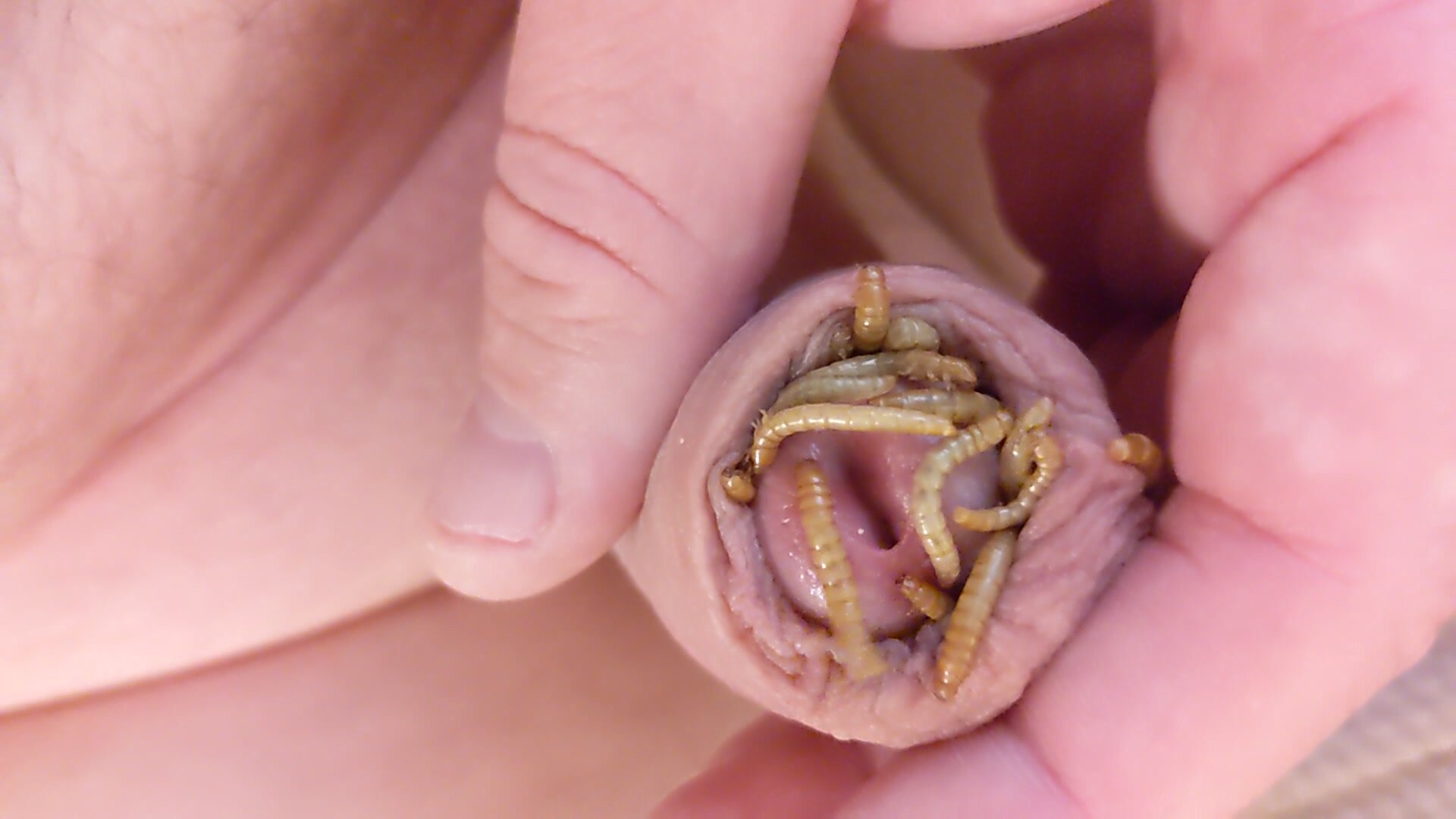 Worms in foreskin