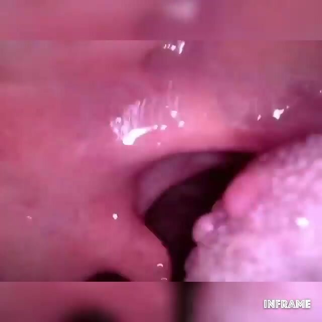 Girl uvula endoscope 2