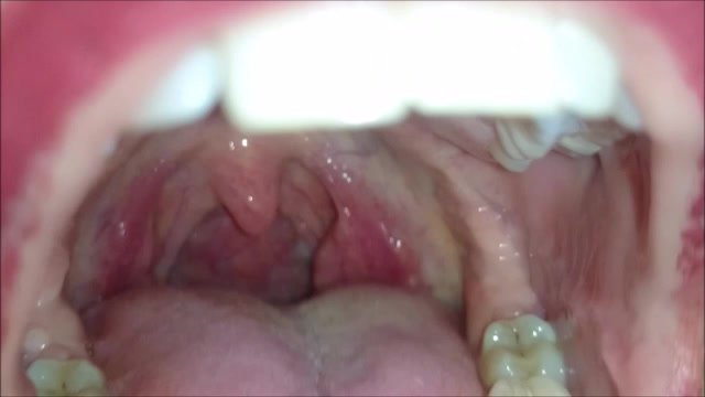 Inside mouth 3