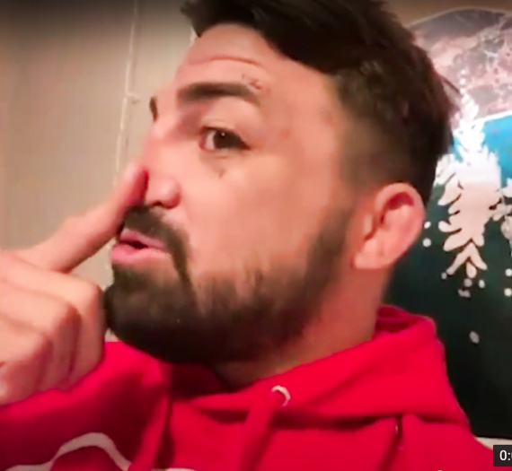 Mike Perry has no Cartilage 2