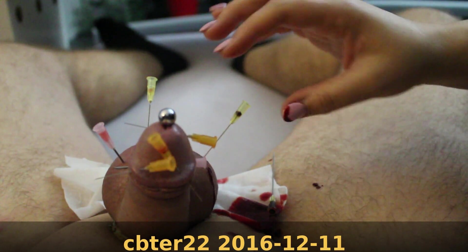 cbter22 2016-12-11 - needles removed pov