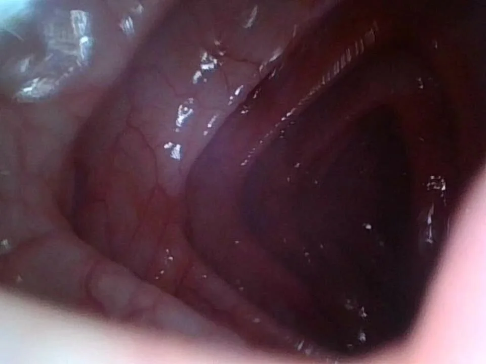 Colon Cam - Endoscopy found uneaten residue in the colon - ThisVid.com