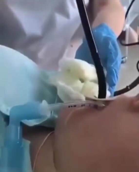 Doctors pulls 4 ft snake from girls mouth
