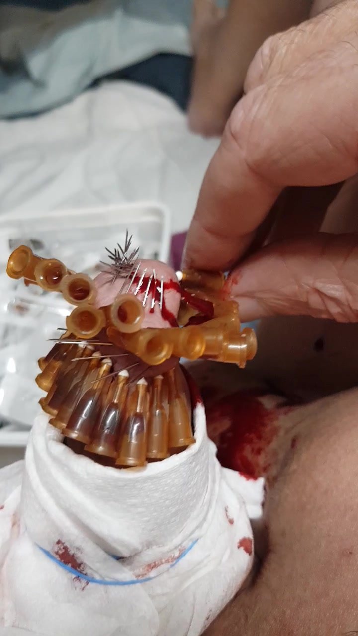 Removing the 49 needles from my left cock head